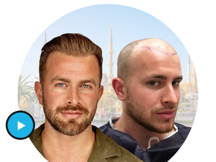 Promotional banner image for BlueMagic Group showcasing their expertise in advanced hair transplantation techniques, including FUE and DHI methods.