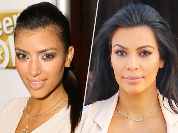 Kim Kardashian Hair Transplant - BlueMagic Group Clinic